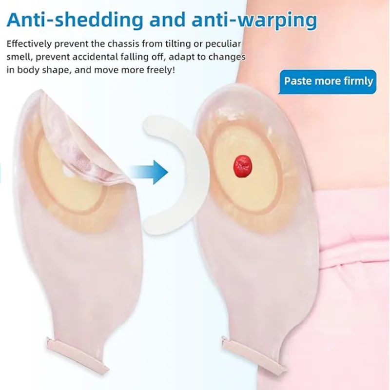 Medizinischer Stoma-Beutel-Ver – Medical Tape Bewertung und Preis